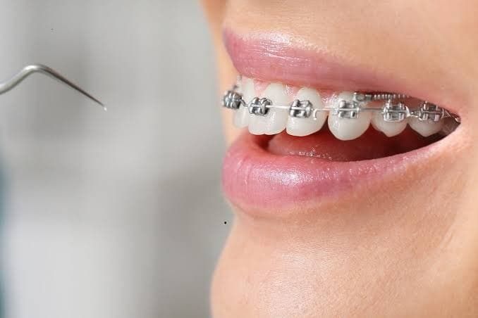 Close-up clinical view of orthodontic braces and archwire being checked with a dental instrument